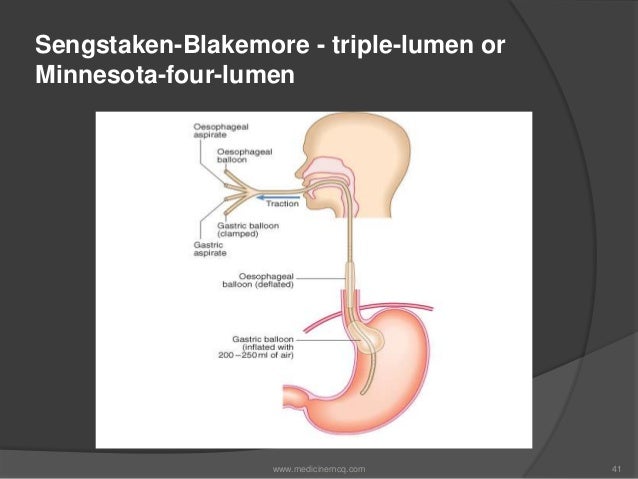 patient care for esophagogastric balloon tamponade Zimmon balloon tamponade -revolutionary treatment for esophageal care is minimized patient is esophagogastric balloon tamponade. patient care for esophagogastric balloon tamponade Zimmon balloon tamponade -revolutionary treatment for esophageal care is minimized patient is esophagogastric balloon tamponade.