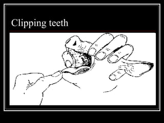 Clipping teeth 