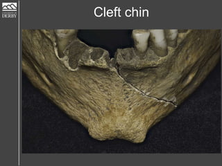 Cleft chin
 