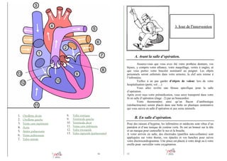 3. Jour de l’intervention

A. Avant la salle d’opération.
Assurez-vous que vous avez ôté votre prothèse dentaire, vos
bijoux, y compris votre alliance, votre maquillage, vernis à ongles, et
que vous portez votre bracelet nominatif au poignet. Les objets
personnels seront enfermés dans votre armoire, la clef sera remise à
l’infirmière.
Veillez à ne pas garder d’objets de valeur lors de votre
hospitalisation (perte, vol….)
Vous allez revêtir une blouse spécifique pour la salle
d’opération.
Après avoir reçu votre prémédication, vous serez transporté dans votre
lit en salle d’opération (étage –2) par un brancardier.
Votre thermomètre ainsi qu’un flacon d’antibiotique
(néobacitracine) seront placés dans une boîte en plastique nominative
qui vous suivra en salle d’opération et aux soins intensifs.

1.
2.
3.
4.
5.
6.
7.

Oreillette droite
Oreillette gauche
Veine cave supérieure
Aorte
Artère pulmonaire
Veine pulmonaire
Valve mitrale

8.
9.
10.
11.
12.
13.

Valve aortique
Ventricule gauche
Ventricule droit
Veine cave inférieure
Valve tricuspide
Valve sigmoïde (pulmonaire)

16

B. En salle d’opération.
Pour des raisons d’hygiène, les infirmières et médecins sont vêtus d’un
pantalon et d’une tunique de couleur verte. Ils ont un bonnet sur la tête
et un masque pour camoufler le nez et la bouche.
A votre arrivée en salle, des électrodes (pastilles auto-collantes) sont
appliquées sur votre thorax, vos épaules et vos hanches pour suivre
votre électrocardiogramme. Une pince est placée à votre doigt ou à votre
oreille pour surveiller votre oxygénation.
17

 