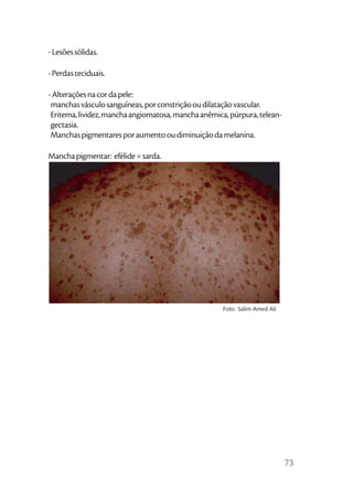 - Lesões sólidas.

- Perdas teciduais.

- Alterações na cor da pele:
 manchas vásculo sanguíneas, por constrição ou dilatação vascular.
 Eritema, lividez, mancha angiomatosa, mancha anêmica, púrpura, telean-
 gectasia.
 Manchas pigmentares por aumento ou diminuição da melanina.

Mancha pigmentar: efélide = sarda.




                                                     Foto: Salim Amed Ali




                                                                            73
 