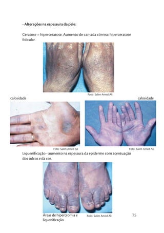 - Alterações na espessura da pele:

       Ceratose = hiperceratose. Aumento de camada córnea: hiperceratose
       folicular.




                                                 Foto: Salim Amed Ali
calosidade                                                                      calosidade




                          Foto: Salim Amed Ali                          Foto: Salim Amed Ali
       Liquenificação - aumento na espessura da epiderme com acentuação
       dos sulcos e da cor.




                   Áreas de hipercromia e        Foto: Salim Amed Ali      75
                   liqueniﬁcação
 