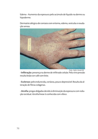 Edema - Aumento da espessura pelo acúmulo de líquido na derme ou
     hipoderme.

     Dermatite alérgica de contato com eritema, edema, vesículas e exuda-
     ção serosa.




                                                             Foto: Salim Amed Ali
     - Infiltração: presença na derme de infiltrado celular. Pela vitro pressão
     resulta lesão cor café com leite.

     - Esclerose: pele endurecida, coriácea, pouco depressível. Resulta da al-
     teração de fibras colágenas.

     - Atrofia: pregas delgadas devido à diminuição da espessura com redu-
     ção tecidual. Atrofia linear é conhecida com víbice.




76
 