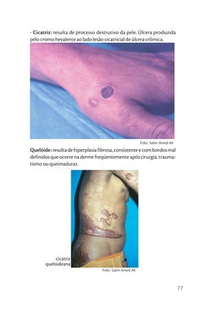 - Cicatriz: resulta de processo destrutivo da pele. Úlcera produzida
pelo cromo hevalente ao lado lesão cicatricial de úlcera crômica.




                                                         Foto: Salim Amed Ali

Quelóide: resulta de hiperplasia fibrosa, consistente e com bordos mal
definidos que ocorre na derme freqüentemente após cirurgia, trauma-
tismo ou queimaduras.




            cicatriz
       queloideana
                                  Foto: Salim Amed Ali




                                                                                77
 