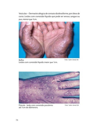 Vesículas – Dermatite alérgica de contato disidrosiforme, por óleos de
     corte. Lesões com conteúdo líquido que pode ser seroso, sangue ou
     pus, menor que 1cm.




     Bolha:                                              Foto: Salim Amed Ali
     Lesões com conteúdo líquido maior que 1cm.




     Pústula - lesão com conteúdo purulento              Foto: Salim Amed Ali
     até 1cm de diâmentro.




78
 