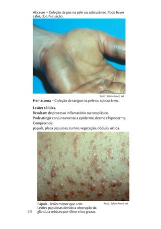 Abcesso – Coleção de pus na pele ou subcutâneo. Pode haver
     calor, dor, ﬂutuação.




                                                 Foto: Salim Amed Ali
     Hematoma – Coleção de sangue na pele ou subcutâneo.
     Lesões sólidas.
     Resultam de processo inflamatório ou neoplásico.
     Pode atingir conjuntamente a epiderme, derme e hipoderme.
     Compreende:
     pápula, placa papulosa, tumor, vegetação, nódulo, urtica.




       Pápula - lesão menor que 1cm.                Foto: Salim Amed Ali
       Lesões papulosas devido a obstrução da
80     glândula sebácea por óleos e/ou graxas.
 