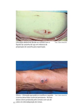Ulceração abdominal devido ao contato com o              Foto: Salim Amed Ali
   líquido da castanha de caju em indústria de
   preparação de castanha para exportação.




   Úlcera – Ulceração que pode se croniﬁcar e quando        Foto: Salim Amed Ali
   cicatriza deixa lesão cicatricial persistente. Na foto
   abaixo úlcera produzida pelo contato com sais de
82 cobre em eletrodeposição de metais.
 
