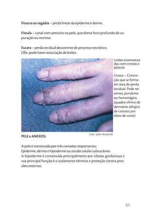 Fissura ou ragádia – perda linear da epiderme e derme.

Fístula – canal com pertuito na pele, que drena foco profundo de su-
puração ou necrose.

Escara – perda tecidual decorrente de processo necrótico.
Obs: pode haver associação de lesões.
                                                                    Lesões eczematiza-
                                                                    das com crostas e
                                                                    pústula

                                                                    Crosta – Concre-
                                                                    ção que se forma
                                                                    em área de perda
                                                                    tecidual. Pode ser
                                                                    serosa, purulenta
                                                                    ou hemorrágica.
                                                                    (quadro clínico de
                                                                    dermatite alérgica
                                                                    de contato por
                                                                    óleos de corte)



                                             Foto: Salim Amed Ali
PELE e ANEXOS:

A pele é constituída por três camadas importantes:
Epiderme, derme e hipoderme ou tecido celular subcutâneo.
A hipoderme é constituída principalmente por células gordurosas e
sua principal função é o isolamento térmico e proteção contra pres-
sões externas.




                                                                           83
 