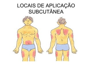 LOCAIS DE APLICAÇÃO
SUBCUTÂNEA

 