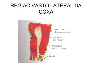REGIÃO VASTO LATERAL DA
COXA

 