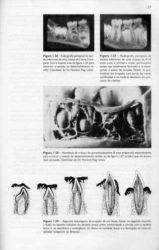 23




Figura l -26 - Radiografia periapical de den-   Figura l -27 - Radiografia periapical de
tes inferiores de uma cria...