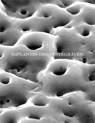 I
IMPLANTES OSSEOINTEGRÁVEIS
 