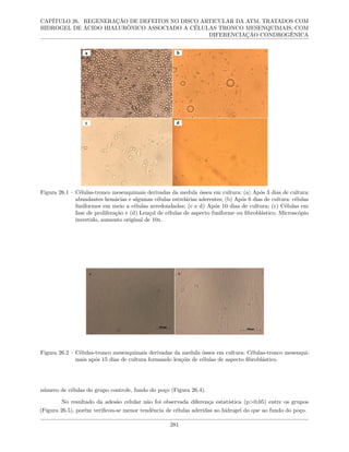 CAPÍTULO 26. REGENERAÇÃO DE DEFEITOS NO DISCO ARTICULAR DA ATM, TRATADOS COM
HIDROGEL DE ÁCIDO HIALURÔNICO ASSOCIADO A CÉLULAS TRONCO MESENQUIMAIS, COM
DIFERENCIAÇÃO CONDROGÊNICA
Figura 26.1 – Células-tronco mesenquimais derivadas da medula óssea em cultura: (a) Após 3 dias de cultura:
abundantes hemácias e algumas células estrelárias aderentes; (b) Após 6 dias de cultura: células
fusiformes em meio a células arredondadas; (c e d) Após 10 dias de cultura; (c) Células em
fase de proliferação e (d) Lençol de células de aspecto fusiforme ou fibroblástico. Microscópio
invertido, aumento original de 10x.
Figura 26.2 – Células-tronco mesenquimais derivadas da medula óssea em cultura: Células-tronco mesenqui-
mais após 15 dias de cultura formando lençóis de células de aspecto fibroblástico.
número de células do grupo controle, fundo do poço (Figura 26.4).
No resultado da adesão celular não foi observada diferença estatística (p>0,05) entre os grupos
(Figura 26.5), porém verificou-se menor tendência de células aderidas ao hidrogel do que ao fundo do poço.
281
 