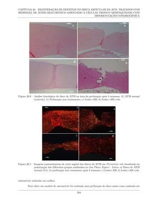 CAPÍTULO 26. REGENERAÇÃO DE DEFEITOS NO DISCO ARTICULAR DA ATM, TRATADOS COM
HIDROGEL DE ÁCIDO HIALURÔNICO ASSOCIADO A CÉLULAS TRONCO MESENQUIMAIS, COM
DIFERENCIAÇÃO CONDROGÊNICA
Figura 26.6 – Análise histológica do disco de ATM na área da perfuração após 8 semanas: A) ATM normal
(controle); b) Perfuração sem tratamento; c) Lesão+AH; d) Lesão+AH+cels.
Figura 26.7 – Imagens representativas de corte sagital dos discos de ATM em Picrosirius red visualizado na
polarização dos diferentes grupos analisados no Las Phase Expert – Leica: a) Disco de ATM
normal (G1); b) perfuração sem tratamento após 8 semanas; c) Lesão+AH; d) Lesão+AH+cels.
osteoartrite induzida em coelhos.
Para obter um modelo de osteoartrite foi realizada uma perfuração do disco assim como realizado em
284
 