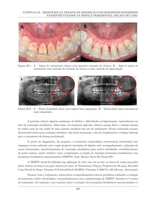 CAPÍTULO 29. BENEFÍCIOS DA TERAPIA DE REPOSIÇÃO COM HORMÔNIOS ESTERÓIDES
NANOESTRUTURADOS NA DOENÇA PERIODONTAL: RELATO DE CASO.
Figura 29.1 – A – Início do tratamento clínico com bastante acúmulo de tártaro. B – Após 6 meses de
tratamento com remissão de acúmulo de tártaro e mais controle da higienização.
Figura 29.2 – A – Pouca densidade óssea com regiões bem esponjosas. B – Trabeculado ósseo encontra-se
mais organizado.
A paciente relatou algumas mudanças de hábitos e dificuldades na higienização, especialmente na
área da contenção ortodôntica. Além disso, em anamnese aplicada, relatou cansaço físico e vontade imensa
de cuidar mais de sua saúde de uma maneira saudável sem uso de medicações. Foram solicitados exames
laboratoriais séricos para avaliação sistêmica e dos níveis hormonais, a fim de complementar a terapia indicada
para o tratamento da doença periodontal.
A partir do diagnóstico, foi proposto o tratamento odontológico convencional periodontal com
raspagem corono radicular sub e supra gengival, instruções de higiene oral, acompanhamento, realização de
novas restaurações, reposicionamento de contenção ortodôntica para conter mobilidade, restabelecimento
de guias caninas, ajuste oclusal e como complemento a terapia de reposição hormonal transdérmica com
hormônios bioidênticos nanoestrurados (TRHTN) (Lab. Buenos Ayres São Paulo/SP).
A TRHTN inicial foi definida com aplicação de 1ml, uma vez ao dia, em áreas do corpo sem pelos
(parte interna do braço e/ou parte interna da coxa), de Testosterona 75mg/g, Progesterona 30 mg/g, Estradiol
5 mg, Estriol de 10mg e Vitamina D (Colecalciferol) 50.000UI, Vitamina A 5000 UI e K2 120 mcg , diariamente.
Durante todo o tratamento, foram feitos acompanhamentos clínicos periódicos avaliando a evolução
do tratamento clínico odontológico, concomitantemente com a administração da TRHTN. Durante os 11 meses
de tratamento, foi realizado o uso contínuo único e exclusivo dos hormônios bioidênticos nanoestrurados e a
308
 
