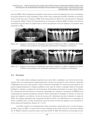 CAPÍTULO 31. MANUTENÇÃO DE SAÚDE DAS ESTRUTURAS MAXILOMANDIBULARES COM
REPOSIÇÃO DE HORMÔNIOS BIOIDÊNTICOS DESENVOLVIDOS POR NANOTECNOLOGIA
BRASILEIRA. RELATO DE CASO
óssea das EMM e fácil visualização da densidade e altura óssea ao redor dos implantes bem como a visualização
da camada endosteal do corpo mandibular. Neste estudo, foram comparadas duas RPs realizadas em intervalos
acima de dois anos antes e depois do TRQ. Como demonstrado na figuras 31.1 anteriormente à realização
do tratamento (2013) e Figura 31.2 posteriormente ao tratamento realizado (2022). O objetivo foi observar
ocorrências de perda óssea na camada óssea ao redor das primeiras roscas de implantes, em paciente idosa
submetida à TRQ.
Figura 31.1 – Imagem convencional da radiografia panorâmica realizada em 2013 e ampliação da mesma.
Utilizada como parâmetro de comparação anteriormente à realização do tratamento.
Figura 31.2 – Imagem convencional da radiografia panorâmica realizada em 2022 e ampliação da mesma.
Utilizada como parâmetro de comparação posteriormente à realização do tratamento.
31.5 Resultados
Este estudo realizou avaliação comparativa por meios clínico, radiológico e por níveis séricos de uma
paciente idosa, que possuía prótese implantossuportada, tratada com remoção de tumor coloretal e submetida
à TRQ alguns anos antes. Esta paciente realizou tratamento odontológico de rotina para manutenção de sua
prótese implantossuportada e cuidados profiláticos orais, além de receber a reposição diária de hormônios
bioidênticos, conforme a avaliação dos níveis hormonais, determinados previamente em exames séricos (Tabela
27). Clinicamente foi observado que o tratamento odontológico em conjunto ao tratamento de RHBTN levou
à diminuição dos sintomas inicialmente descritos. Houve diminuição na formação de tártaros ao redor dos
pilares dos implantes, na ardência e secura da mucosa oral e diminuição das dores relatadas em região de
ATMs. Na avaliação radiográfica pela comparação das RP anos 2013 e ano 2022 observou-se a manutenção de
altura e qualidade óssea, ao redor das primeiras roscas dos terços cervicais dos implantes, sem ocorrências de
perdas ósseas peri-implantares (Figuras 31.1 e 31.2).
O período completo de acompanhamento clínico da paciente compreendeu entre os meses de janeiro
de 2021 a março de 2022 e os exames séricos foram realizados dentro deste intervalo de observação (Tabela
27). O TRQ foi realizado na paciente quatro anos antes da RP de 2022. Pela distância da localização da área
327
 