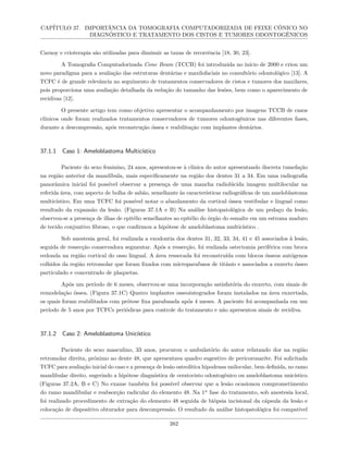 CAPÍTULO 37. IMPORTÂNCIA DA TOMOGRAFIA COMPUTADORIZADA DE FEIXE CÔNICO NO
DIAGNÓSTICO E TRATAMENTO DOS CISTOS E TUMORES ODONTOGÊNICOS
Carnoy e crioterapia são utilizadas para diminuir as taxas de recorrência [18, 30, 23].
A Tomografia Computadorizada Cone Beam (TCCB) foi introduzida no início de 2000 e criou um
novo paradigma para a avaliação das estruturas dentárias e maxilofaciais no consultório odontológico [13]. A
TCFC é de g