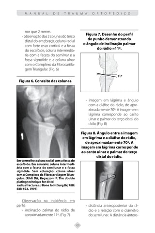 105
M A N U A L D E T R A U M A O R T O P É D I C O
nor que 2 mmm.
-observaçãodas3colunasdoterço
distal do antebraço, coluna radial
com forte osso cortical e a fossa
do escafóide, coluna intermediá-
ria com a faceta do semilnar e a
fossa sigmóide e, a coluna ulnar
com o Complexo da Fibrocartila-
gem Triangular. (Fig. 6)
Figura 6. Conceito das colunas.
Em vermelho: coluna radial com a fossa do
escafóide. Em amarelo: coluna intermedi-
ária com a faceta do semilunar e a fossa
sigmóide. Sem coloração: coluna ulnar
com o Complexo da FibrocartilagemTrian-
gular. (Rikli DA, Regazzoni P. The double
plating technique for distal
radius fractures. J Bone Joint Surg Br; 78B:
588-592, 1996)
Observação na incidência em
perfil:
- inclinação palmar do rádio de
aproximadamente 11º. (Fig. 7)
Figura 7. Desenho do perfil
do punho demonstrando
o ângulo de inclinação palmar
do rádio =11º.
- imagem em lágrima e ângulo
com a diáfise do rádio, de apro-
ximadamente 70º. A imagem em
lágrima corresponde ao canto
ulnar e palmar do terço distal do
rádio (Fig. 8)
Figura 8. Ângulo entre a imagem
em lágrima e a diáfise do rádio,
de aproximadamente 70º. A
imagem em lágrima corresponde
ao canto ulnar e palmar do terço
distal do rádio.
- distância anteroposterior do rá-
dio e a relação com o diâmetro
do semilunar. A distância ântero-
 