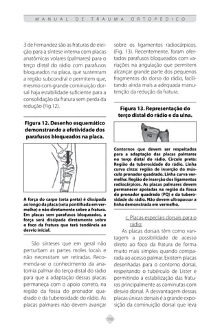 110
M A N U A L D E T R A U M A O R T O P É D I C O
3 de Fernandez são as fraturas de elei-
ção para a síntese interna com placas
anatômicas volares (palmares) para o
terço distal do rádio com parafusos
bloqueados na placa, que sustentam
a região subcondral e permitem que,
mesmo com grande cominuição dor-
sal haja estabilidade suficiente para a
consolidação da fratura sem perda da
redução (Fig.12).
Figura 12. Desenho esquemático
demonstrando a efetividade dos
parafusos bloqueados na placa.
A força do carpo (seta preta) é dissipada
ao longo da placa (seta pontilhada em ver-
melho) e não diretamente sobre a fratura.
Em placas sem parafusos bloqueados, a
força será dissipada diretamente sobre
o foco da fratura que terá tendência ao
desvio inicial.
São sínteses que em geral não
perturbam as partes moles locais e
não necessitam ser retiradas. Reco-
menda-se o conhecimento da ana-
tomia palmar do terço distal do rádio
para que a adaptação dessas placas
permaneça com o apoio correto, na
região da fossa do pronador qua-
drado e da tuberosidade do rádio. As
placas palmares não devem avançar
sobre os ligamentos radiocárpicos.
(Fig. 13). Recentemente, foram ofer-
tados parafusos bloqueados com va-
riações na angulação que permitem
alcançar grande parte dos pequenos
fragmentos do dorso do rádio, facili-
tando ainda mais a adequada manu-
tenção da redução da fratura.
Figura 13. Representação do
terço distal do rádio e da ulna.
Contornos que devem ser respeitados
para a adaptação das placas palmares
no terço distal do rádio. Círculo preto:
Região da tuberosidade do rádio. Linha
curva cinza: região de inserção do mús-
culo pronador quadrado. Linha curva ver-
melha: Região de inserção dos ligamentos
radiocárpicos. As placas palmares devem
permanecer apoiadas na região da fossa
do pronador quadrado (PQ) e da tubero-
sidade do rádio. Não devem ultrapassar a
linha demonstrada em vermelho.
c. Placas especiais dorsais para o
rádio:
As placas dorsais têm como van-
tagem a possibilidade de acesso
direto ao foco da fratura de forma
muito mais simples quando compa-
rada ao acesso palmar. Existem placas
desenhadas para o contorno dorsal,
respeitando o tubérculo de Lister e
permitindo a estabilização das fratu-
ras principalmente as cominutas com
desvio dorsal. A desvantagem dessas
placas únicas dorsais é a grande expo-
sição da cominuição dorsal que leva
 