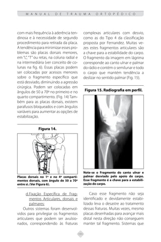 111
M A N U A L D E T R A U M A O R T O P É D I C O
com mais frequência à aderência ten-
dinosa e à necessidade de segundo
procedimento para retirada da placa.
A tendência para minimizar esses pro-
blemas são placas dorsais menores,
em “L”, “T” ou retas, na coluna radial e
na intermediária (ver conceito de co-
lunas na fig. 6). Essas placas podem
ser colocadas por acessos menores
sobre o fragmento específico que
está desviado, diminuindo a agressão
cirúrgica. Podem ser colocadas em
ângulos de 50 a 70º no primeiro e no
quarto compartimento. (Fig. 14) Tam-
bém para as placas dorsais, existem
parafusos bloqueados e com ângulos
variáveis para aumentar as opções de
estabilização.
Figura 14.
Placas dorsais no 1º e no 4º comparti-
mentos dorsais, com ângulo de 50 a 70º
entre si. (Ver Figura 6).
d.Fixação Específica de Frag-
mentos Articulares, dorsais e
palmares:
Outros sistemas foram desenvol-
vidos para privilegiar os fragmentos
articulares que podem ser avulsio-
nados, correspondendo às fraturas
complexas articulares com desvio,
como as do Tipo 4 da classificação
proposta por Fernandez. Muitas ve-
zes estes fragmentos articulares são
a chave para a estabilidade do carpo.
O fragmento da imagem em lágrima
corresponde ao canto ulnar e palmar
do rádio e contém o semilunar e todo
o carpo que mantém tendência a
deslizar no sentido palmar (Fig. 15).
Figura 15. Radiografia em perfil.
Note-se o Fragmento do canto ulnar e
palmar desviado pelo apoio do carpo.
Esse fragmento é a chave para a estabili-
zação do carpo.
Caso esse fragmento não seja
identificado e devidamente estabi-
lizado leva o desastre ao tratamento
dessas fraturas. Muitas vezes, mesmo
placas desenhadas para avançar mais
distal nesta direção não conseguem
manter tal fragmento. Sistemas que
 
