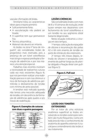 135
M A N U A L D E T R A U M A O R T O P É D I C O
vascular e formações de bridas.
Strickland listou as características
ideais para o reparo primário:
Suficientemente forte;
y
y
A vascularização não poderá ser
y
y
lesada;
A superfície tem que permanecer
y
y
lisa;
Técnica atraumática;
y
y
Material não deverá ser irritante.
y
y
As lesões na zona II “terra de nin-
guém”, são consideradas lesões de
prognóstico mais reservado, pois a
presença de um túnel osteofibroso
mais longo e espesso predispõe a for-
mação de aderências e por isso me-
rece uma atenção especial.
Trabalhos mais recentes mostram
a necessidade de realizarmos suturas
cada vez mais resistentes (figura 4),
que nos permitam realizar uma reabi-
litação precoce e com isso diminuir o
risco de formação de aderências per-
mitindo o deslizamento do tendão
com mínimo de atrito possível.
A tenólise está indicada quando
não temos uma excursão adequada
do tendão, em decorrência da forma-
ção de aderências após quatro a seis
meses de reabilitação.
Figura 4. Exemplos de suturas
com duas e quatro passagens
Lesões crônicas
São consideradas lesões com mais
de 8 a 10 semanas de evolução, onde
quase sempre nos deparamos com
fechamento do túnel osteofibroso e
um tendão no seu segmento distal
bastante degenerado.
Nesta situação indicamos a cirur-
gia em dois tempos.
1o
tempo:colocaçãodoespaçador
de silicone e reconstrução das polias
A2 e A4 com enxerto de tendão ou
parte do retináculo dos extensores.
2o
tempo: três meses depois, re-
tirada do silicone e tenoplastia com
enxerto do palmar longo ou do plan-
tar delgado e fixação distal com pull-
out (figura 5)
Figura 5. Pull-out
Lesão dos tendões
extensores
Por se tratar de uma estrutura
anatômica superficial as lesões en-
volvendo os tendões extensores tam-
bém são muito frequentes. Como em
toda área da mão o conhecimento da
anatomia do aparelho extensor é cru-
cial para o entendimento das lesões e
seu tratamento.
 