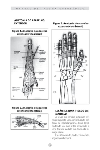 136
M A N U A L D E T R A U M A O R T O P É D I C O
Anatomia do aparelho
extensor.
Figura 1. Anatomia do aparelho
extensor (vista dorsal)
Figura 2. Anatomia do aparelho
extensor (vista lateral)
Figura 2. Anatomia do aparelho
extensor (vista lateral)
Lesão na zona I - DEDO EM
MARTELO
A lesão do tendão extensor ter-
minal acarreta uma deformidade em
flexo da intefalangeana distal (IFD),
podendo ou não estar associado a
uma fratura avulsão do dorso da fa-
lange distal.
Classificação do dedo em martelo
segundo Albertoni.
 