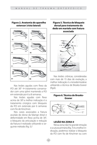 137
M A N U A L D E T R A U M A O R T O P É D I C O
Figura 2. Anatomia do aparelho
extensor (vista lateral)
Nas lesões agudas com flexo da
IFD até 300
tratamento conserva-
dor com uma splint mantendo a IFD
em extensão por 6 a 8 semanas.
Nas lesões agudas com flexo
acima de 300
a melhor indicação é o
tratamento cirúrgico com bloqueio
da IFD em extensão por 6 semanas
com fio de Kirschner.
Nos casos associados a fratura
avulsão do dorso da falange distal e
deformidade em flexo acima de 300
,
o bloqueio da articulação e redução
da fratura é realizado utilizando o se-
guinte método (fig. 5).3
Figura 5. Técnica de bloqueio
dorsal para tratamento do
dedo em martelo com fratura
associada
Nas lesões crônicas, consideradas
com mais de 15 dias de evolução, a
melhor indicação é a tenodermodese
utilizando a técnica de Brooks-Graner
(fig.6).
Figura 6. Técnica de Brooks-
Graner
Lesão na zona II
Nessa zona não há grande retração
easuturaprimária(fig.7)éamelhorin-
dicação, podemos realizar o bloqueio
da IFD com fio de Kirschner ou com
 