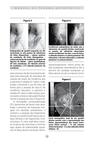 146
M A N U A L D E T R A U M A O R T O P É D I C O
pela presença da dor local potenciali-
zada pela execução de manobras de
rotação do corpo. Na incidência alar,
o paciente é rodado 45o
sobre o lado
lesado, colocando a asa do ilíaco de
frente para a ampola de raios-X. Na
incidência obturatriz, o paciente é
rodado 45o
sobre o lado íntegro, posi-
cionando o forame obturador frontal-
mente à ampola de raios-X (Figura 4).
A tomografia computadorizada
(TC) demonstra de forma mais deta-
lhada a presença de impacção mar-
ginal nas rebordas acetabulares, o
número e a posição dos fragmentos
ósseos, e a existência de fratura da ca-
beça femoral e de fragmentos intra-
articulares. O corte axial deve iniciar-
se na altura da crista ilíaca e terminar
logo abaixo da tuberosidade isquiá-
tica. As fatias devem ser de até 10mm.
Aproximadamente 10mm acima do
teto acetabular, estendendo-se até o
término da cavidade acetabular, as
fatias devem ser de no máximo 2mm,
Figura 3
Radiografias do quadril esquerdo em AP,
mostrando os seis pontos de referência:
(A) linha iliopectínea – coluna anterior
do acetábulo, (B) linha ilioisquiática –
coluna posterior do acetábulo, (C) gota de
lágrima de Köhler – placa quadrilateral,
(D) teto acetabular, (E) reborda anterior
do acetábulo, e (F) reborda posterior do
acetábulo.
Figura 4
Incidências radiográficas de Judet, alar e
obturatriz, do quadril direito, mostrando
os pontos de referência observados
nestas incidências. Na alar, a asa do ilíaco,
o rebordo anterior e a coluna posterior. Na
obturatriz, o forame obturador, o rebordo
posterior e a coluna anterior.
Figura 5
Corte tomográfico axial de um quadril
direito normal, com a representação das
linhas representativas dos traços trans-
verso (linha vertical – T), das colunas
(linha horizontal – C) e dos rebordos (linha
oblíqua – R).
 
