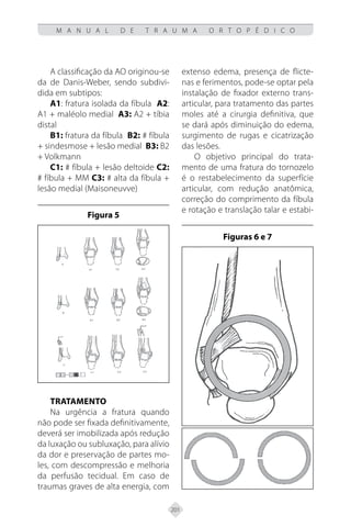 201
M A N U A L D E T R A U M A O R T O P É D I C O
A classificação da AO originou-se
da de Danis-Weber, sendo subdivi-
dida em subtipos:
A1: fratura isolada da fíbula A2:
A1 + maléolo medial A3: A2 + tíbia
distal
B1: fratura da fíbula B2: # fíbula
+ sindesmose + lesão medial B3: B2
+ Volkmann
C1: # fíbula + lesão deltoide C2:
# fíbula + MM C3: # alta da fíbula +
lesão medial (Maisoneuvve)
Figura 5
Tratamento
Na urgência a fratura quando
não pode ser fixada definitivamente,
deverá ser imobilizada após redução
da luxação ou subluxação, para alívio
da dor e preservação de partes mo-
les, com descompressão e melhoria
da perfusão tecidual. Em caso de
traumas graves de alta energia, com
extenso edema, presença de flicte-
nas e ferimentos, pode-se optar pela
instalação de fixador externo trans-
articular, para tratamento das partes
moles até a cirurgia definitiva, que
se dará após diminuição do edema,
surgimento de rugas e cicatrização
das lesões.
O objetivo principal do trata-
mento de uma fratura do tornozelo
é o restabelecimento da superfície
articular, com redução anatômica,
correção do comprimento da fíbula
e rotação e translação talar e estabi-
Figuras 6 e 7
 