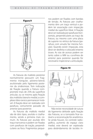 203
M A N U A L D E T R A U M A O R T O P É D I C O
Figura 9
As fraturas do maléolo posterior
normalmente possuem um frag-
mento triangular, póstero-lateral,
avulsionado pelo ligamento poste-
rior da sindesmose. Tem indicação
de fixação quando a fratura com-
promete mais de 25% da superfície
articular, ou se mesmo após fixação
dos maléolos lateral e medial, o com-
plexo tibio-tarsico permanecer instá-
vel. A fixação deve ser realizada com
parafuso, comumente passado de
anterior para posterior.
As fraturas do maléolo medial
são de dois tipos, avulsão e cisalha-
mento, sendo a primeira mais co-
mum. As fraturas por avulsão têm
traço transverso e podem ser fixadas
com parafusos de tração, perpendi-
culares ao foco. Fragmentos peque-
nos podem ser fixados com bandas
de tensão. As fraturas por cisalha-
mento têm um traço vertical e po-
dem ter associação com impacção
medial da superfície tibial. A fixação
deve ser realizada por parafusos hori-
zontais, perpendiculares ao traço da
fratura, ou mesmo com uma placa
de suporte no vértice da fratura (pa-
rafuso com arruela faz mesma fun-
ção). Quando existir impacção, esta
deve ser desfeita e colocado enxerto
ósseo. As vias de acesso podem ser
tanto sobre o MM ou curvilínea de
anterior para posterior quando for
necessário inspecionar a articulação.
Figura 10
Não existe necessidade de sutura
do ligamento deltoide após fixação
das fraturas, se o tornozelo ficar es-
tável e a reconstrução for anatômica.
Se ainda houver, no controle radio-
gráfico, aumento do espaço claro
medial, este deverá ser explorado
para desbridamento de tecidos in-
 