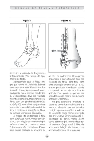 204
M A N U A L D E T R A U M A O R T O P É D I C O
terpostos e retirada de fragmentos
osteocondrais e/ou sutura do liga-
mento deltoide.
Asindesmosedeveserfixadasem-
pre que houver instabilidade. Sabe-se
que raramente estará lesada nas fra-
turas do tipo A, às vezes nas fraturas
do tipo B e quase sempre nas do tipo
C. O diagnóstico deve ser realizado
no intra-operatório, tracionando-se a
fíbula com um gancho (teste de Cot-
ton) (fig 12). Normalmente quando se
restabelece a estabilidade medial, la-
teral e posterior, a aposição da fíbula
na incisura se mantém adequada.
A fixação da sindesmose é feita
com parafusos, não havendo concor-
dância em relação ao número de pa-
rafusos, um ou 2 e o tamanho destes,
3,5mm com três corticais ou 4,5mm
com quatro corticais, ou se acima ou
ao nível da sindesmose. Um aspecto
importante é que a fixação deve ser
realizada da fíbula para tíbia com
uma angulação anterior de 25° à 30°,
e estes parafusos não devem ser de
compressão e sim de estabilização
articular. Estes parafusos podem ser
retirados ou não, mas se forem nunca
antes de 12 semanas.
No pós operatório imediato o
paciente deve ficar imobilizado e o
membro elevado para ser evitados
posição rígida em eqüino e edema
do tornozelo. Carga parcial protegida
por órtese deve ser iniciada após ci-
catrização de partes moles, assim
como estímulo para mobilidade to-
tal articular. Carga total é liberada
após consolidação da fratura, com
aproximadamente oito semanas.
Figura 11 Figura 12
 