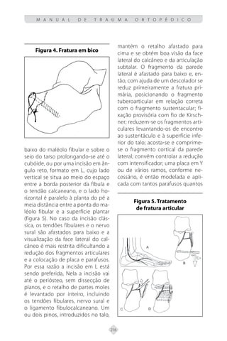 216
M A N U A L D E T R A U M A O R T O P É D I C O
baixo do maléolo fibular e sobre o
seio do tarso prolongando-se até o
cubóide, ou por uma incisão em ân-
gulo reto, formato em L, cujo lado
vertical se situa ao meio do espaço
entre a borda posterior da fíbula e
o tendão calcaneano, e o lado ho-
rizontal é paralelo à planta do pé a
meia distância entre a ponta do ma-
léolo fibular e a superfície plantar
(figura 5). No caso da incisão clás-
sica, os tendões fibulares e o nervo
sural são afastados para baixo e a
visualização da face lateral do cal-
câneo é mais restrita dificultando a
redução dos fragmentos articulares
e a colocação de placa e parafusos.
Por essa razão a incisão em L está
sendo preferida, Nela a incisão vai
até o periósteo, sem dissecção de
planos, e o retalho de partes moles
é levantado por inteiro, incluindo
os tendões fibulares, nervo sural e
o ligamento fibulocalcaneano. Um
ou dois pinos, introduzidos no talo,
mantém o retalho afastado para
cima e se obtém boa visão da face
lateral do calcâneo e da articulação
subtalar. O fragmento da parede
lateral é afastado para baixo e, en-
tão, com ajuda de um descolador se
reduz primeiramente a fratura pri-
mária, posicionando o fragmento
tuberoarticular em relação correta
com o fragmento sustentacular; fi-
xação provisória com fio de Kirsch-
ner; reduzem-se os fragmentos arti-
culares levantando-os de encontro
ao sustentáculo e à superfície infe-
rior do talo; acosta-se e comprime-
se o fragmento cortical da parede
lateral; convém controlar a redução
com intensificador; uma placa em Y
ou de vários ramos, conforme ne-
cessário, é então modelada e apli-
cada com tantos parafusos quantos
Figura 4. Fratura em bico
Figura 5. Tratamento
de fratura articular
 