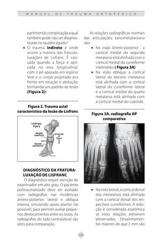 220
M A N U A L D E T R A U M A O R T O P É D I C O
partimental;complicaçãoaqual
também pode não ser diagnos-
ticada no quadro agudo.4
• O trauma indireto é onde
ocorre a maioria das fraturas-
luxações de Lisfranc. É cau-
sada quando a força é apli-
cada no eixo longitudinal,
com o pé apoiado em eqüino
leve e o corpo projetado pra
frente em rotação e abdução,
formando um padrão de lesão
(Figura 2):
Figura 2. Trauma axial
característico da lesão de Lisfranc
DIAGNÓSTICO DA FRATURA-
LUXAÇÃO DE LISFRANC
O diagnóstico requer atenção do
examinador em alto grau. O paciente
politraumatizado deve ser avaliado
com radiografias nas incidências
ântero-posterior, lateral e oblíqua
interna, simulando apoio plantar (se
possível), para permitir avaliar peque-
nos deslocamentos entre os ossos. As
radiografias do lado contralateral são
úteis para comparação.
As relações radiográficas normais
das articulações tarsometatarsiana
são:
• Na visão ântero-posterior : a
cortical medial do segundo
metatarso está alinhada com a
cortical medial do cuneiforme
intermédio ( Figura 3A)
• Na visão oblíqua: a cortical
lateral do terceiro metatarso
está alinhada com a cortical
lateral do cuneiforme lateral
e a cortical medial do quarto
metatarso está alinhada com
a cortical medial do cubóide.
Figura 3A. radiografia AP
comparativa
• Navistalateral,acorticaldorsal
dos metatarsos está alinhada
com a cortical dorsal dos res-
pectivos cuneiformes. A redu-
ção é considerada anatômica
se estas relações estiverem
preservadas. Desalinhamen-
tos maiores do que 2 mm são
 