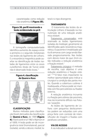 221
M A N U A L D E T R A U M A O R T O P É D I C O
caracterizadas como redução
não-anatômica2
( Figura 3B).
Figura 3B. perfil mostrando a
lesão evidenciada no pé E
A tomografia computadorizada
identifica aumento do espaço entre
o primeiro e o segundo metatarsais
nas lesões do ligamento de Lisfranc.
E a ressonância magnética pode au-
xiliar na identificação de lesões iso-
ladas de ligamentos entre os ossos
cuneiformes (lesão de Turco) onde
não é observado lesão óssea. 3
Figura 4. classificação
de Quenú e Kuss
Classificação
Muitos métodos para classifica-
ção foram derivados da classificação
de Quenú e Kuss, de 1909 (figura
4) ( hard castle et al 1982 e Myerson et
al 1009). A lesão pode ser de incon-
gruência total (homolateral), parcial
(isolada), sendo o desvio: medial, la-
teral e o tipo divergente.
TRATAMENTO
O tratamento das lesões da ar-
ticulação Lisfranc é baseado na ma-
nutenção de uma redução anatô-
mica estável.
Tratamento conservador: está
reservado as lesões ligamentares
isoladas do mediopé, geralmente só
identificadas após ressonância mag-
nética. O paciente é imobilizado por
6 a 8 semanas com carga sendo libe-
rada progressivamente. Nas lesões
com desvio maior do que 2mm es-
tão indicadas a redução anatômica
e fixação estável. 1
Tratamento cirúrgico: é método
de escolha, cujo objetivo é uma
redução anatômica e fixação está-
vel 1,2,4-6.
O fator mais importante na
melhor oportunidade para indicar a
cirurgia é a condição das partes mo-
les. Quando a cobertura cutânea é
inadequada, a fratura pode ser man-
tida com fios percutâneos ou fixador
externo.
A redução anatômica incruenta
e a fixação percutânea são possíveis,
mas tecnicamente difíceis nas fratu-
ras- luxações.
As lesões do ligamento de Lis-
franc com pequenos deslocamen-
tos podem ser reduzidas com uma
pinça forte com controle de inten-
sificador de imagem e fixadas com
parafusos canulados .
VIA DE ACESSO
A via indicada é a dorsal com inci-
 