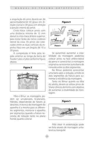 25
M A N U A L D E T R A U M A O R T O P É D I C O
a angulação do pino deverá ser de
aproximadamente 20 graus em di-
reção cranial e 30 graus em direção
a porção interna da pelve.
Crista ilíaca: colocar pinos com
uma distância mínima de 15 mm
dorsal à crista ilíaca ântero-superior,
para evitar lesão do nervo cutâneo
lateral da coxa. Os pinos são colo-
cados entre as duas corticais da es-
pinha ilíaca em um ângulo de 10 a
20 graus.
A compressão é feita pela re-
gião anterior ao longo da barra do
fixador tubo a tubo conforme figura
abaixo.
Figura 3
Tíbia e fêmur: as montagens po-
dem ser uni-planares, bi-planares,
híbridas, dependendo de fatores já
descritos. A técnica de montagem do
aparelho é a mesma para os diferen-
tes segmentos, monta-se o aparelho
por segmentos quando a fratura ne-
cessita de redução tanto no plano
frontal, quanto coronal.
Figura 4
Passo 1
Passo 3
Passo 2
Passo 4
Se quisermos aumentar a esta-
bilidade da montagem podemos
colocar pinos na face antero-lateral
da perna e conectá-los à montagem
original ou acrescentar outra barra de
conexão entre os dois segmentos.
No fêmur, podemos acrescentar
uma barra após a redução, unindo os
dois segmentos da fratura para au-
mentar a resistência da montagem.
Tanto no fêmur quanto na tíbia
do adulto, devem-se utilizar pinos de
Shanz cônicos de 6 mm com objetivo
de aumentar a estabilidade da mon-
tagem.
Figura 5
Pilão tibial: A estabilização pode
ser feita através de montagem unila-
teral ou triangular.
 