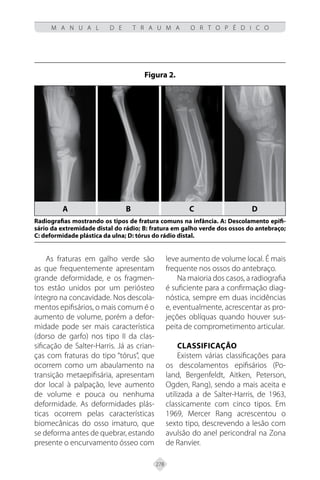278
M A N U A L D E T R A U M A O R T O P É D I C O
As fraturas em galho verde são
as que frequentemente apresentam
grande deformidade, e os fragmen-
tos estão unidos por um periósteo
íntegro na concavidade. Nos descola-
mentos epifisários, o mais comum é o
aumento de volume, porém a defor-
midade pode ser mais característica
(dorso de garfo) nos tipo II da clas-
sificação de Salter-Harris. Já as crian-
ças com fraturas do tipo “tórus”, que
ocorrem como um abaulamento na
transição metaepifisária, apresentam
dor local à palpação, leve aumento
de volume e pouca ou nenhuma
deformidade. As deformidades plás-
ticas ocorrem pelas características
biomecânicas do osso imaturo, que
se deforma antes de quebrar, estando
presente o encurvamento ósseo com
Figura 2.
Radiografias mostrando os tipos de fratura comuns na infância. A: Descolamento epifi-
sário da extremidade distal do rádio; B: fratura em galho verde dos ossos do antebraço;
C: deformidade plástica da ulna; D: tórus do rádio distal.
A b c d
leve aumento de volume local. É mais
frequente nos ossos do antebraço.
Na maioria dos casos, a radiografia
é suficiente para a confirmação diag-
nóstica, sempre em duas incidências
e, eventualmente, acrescentar as pro-
jeções oblíquas quando houver sus-
peita de comprometimento articular.
Classificação
Existem várias classificações para
os descolamentos epifisários (Po-
land, Bergenfeldt, Aitken, Peterson,
Ogden, Rang), sendo a mais aceita e
utilizada a de Salter-Harris, de 1963,
classicamente com cinco tipos. Em
1969, Mercer Rang acrescentou o
sexto tipo, descrevendo a lesão com
avulsão do anel pericondral na Zona
de Ranvier.
 