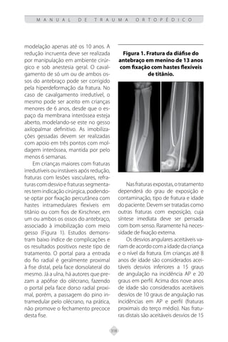 318
M A N U A L D E T R A U M A O R T O P É D I C O
modelação apenas até os 10 anos. A
redução incruenta deve ser realizada
por manipulação em ambiente cirúr-
gico e sob anestesia geral. O caval-
gamento de só um ou de ambos os-
sos do antebraço pode ser corrigido
pela hiperdeformação da fratura. No
caso de cavalgamento irredutível, o
mesmo pode ser aceito em crianças
menores de 6 anos, desde que o es-
paço da membrana interóssea esteja
aberto, modelando-se este no gesso
axilopalmar definitivo. As imobiliza-
ções gessadas devem ser realizadas
com apoio em três pontos com mol-
dagem interóssea, mantida por pelo
menos 6 semanas.
Em crianças maiores com fraturas
irredutíveis ou instáveis após redução,
fraturas com lesões vasculares, refra-
turas com desvio e fraturas segmenta-
res tem indicação cirúrgica, podendo-
se optar por fixação percutânea com
hastes intramedulares flexíveis em
titânio ou com fios de Kirschner, em
um ou ambos os ossos do antebraço,
associado à imobilização com meio
gesso (Figura 1). Estudos demons-
tram baixo índice de complicações e
os resultados positivos neste tipo de
tratamento. O portal para a entrada
do fio radial é geralmente proximal
à fise distal, pela face dorsolateral do
mesmo. Já a ulna, há autores que pre-
zam a apófise do olécrano, fazendo
o portal pela face dorso radial proxi-
mal, porém, a passagem do pino in-
tramedular pelo olécrano, na prática,
não promove o fechamento precoce
desta fise.
Figura 1. Fratura da diáfise do
antebraço em menino de 13 anos
com fixação com hastes flexíveis
de titânio.
Nasfraturasexpostas,otratamento
dependerá do grau de exposição e
contaminação, tipo de fratura e idade
do paciente. Devem ser tratadas como
outras fraturas com exposição, cuja
síntese imediata deve ser pensada
com bom senso. Raramente há neces-
sidade de fixação externa.
Os desvios angulares aceitáveis va-
riam de acordo com a idade da criança
e o nível da fratura. Em crianças até 8
anos de idade são considerados acei-
táveis desvios inferiores a 15 graus
de angulação na incidência AP e 20
graus em perfil. Acima dos nove anos
de idade são considerados aceitáveis
desvios de 10 graus de angulação nas
incidências em AP e perfil (fraturas
proximais do terço médio). Nas fratu-
ras distais são aceitáveis desvios de 15
 