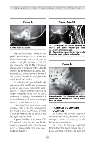 330
M A N U A L D E T R A U M A O R T O P É D I C O
Algumasmedidasnaradiografiaem
perfil são utilizadas: a linha de Wacke-
nheimdevetangenciarposteriormente
o clivus e a região superior e posterior
do odontoide (Fig 2). Na articulação
atlanto-axial a distância entre a borda
anteriordodentedoáxisea bordapos-
teriordoarcoanteriordoAtlasénormal
até 4,5 mm, devido à cartilagem não
ossificada do odontoide.
Os critérios de instabilidade da
coluna cervical no RX são: angulação
entre os processos espinhosos adja-
centes > 11 graus e translação entre os
corpos vertebrais de 3,5 mm, no perfil,
aumento do espaço intervertebral e
mau alinhamento dos processos espi-
nhosos, na incidência anterior.
Crianças podem apresentar lesão
medular sem evidência radiográfica
de lesão óssea (SCIWORA), devido
à grande mobilidade da coluna nas
crianças. Figura 3A e B.
A pseudo-subluxação entre C2-
C3, normalmente notada no RX di-
nâmico, é considerada normal e não
deve ser confundida com lesões ver-
dadeiras. Figura 4
FRATURAS DO CONDILO
OCCIPITAL
As fraturas do côndilo occipital
são raras na criança, devendo ser in-
vestigada quando na presença de dé-
ficit de nervo craniano.
Três tipos de fraturas occipitais
foram descritos: tipo I, fratura por im-
pactação; tipo II, fratura de base do
Figura 2.
A linha de Wackenheim.
Figuras 3A e 3B.
3A – Radiografia de coluna cervical de
criança com déficit neurológico após
queda sem alteração óssea.
3B–Ressonânciamagnéticacervicalrevela
lesão não observada na radiografia.
Figura 4.
Pseudoluxação C2-C3 fisiológica é melhor
percebida na radiografia cervical dinâ-
mica em flexão.
 