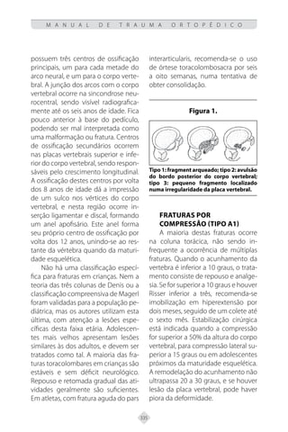 335
M A N U A L D E T R A U M A O R T O P É D I C O
possuem três centros de ossificação
principais, um para cada metade do
arco neural, e um para o corpo verte-
bral. A junção dos arcos com o corpo
vertebral ocorre na sincondrose neu-
rocentral, sendo visível radiografica-
mente até os seis anos de idade. Fica
pouco anterior à base do pedículo,
podendo ser mal interpretada como
uma malformação ou fratura. Centros
de ossificação secundários ocorrem
nas placas vertebrais superior e infe-
rior do corpo vertebral, sendo respon-
sáveis pelo crescimento longitudinal.
A ossificação destes centros por volta
dos 8 anos de idade dá a impressão
de um sulco nos vértices do corpo
vertebral, e nesta região ocorre in-
serção ligamentar e discal, formando
um anel apofisário. Este anel forma
seu próprio centro de ossificação por
volta dos 12 anos, unindo-se ao res-
tante da vértebra quando da maturi-
dade esquelética.
Não há uma classificação especí-
fica para fraturas em crianças. Nem a
teoria das três colunas de Denis ou a
classificação compreensiva de Magerl
foram validadas para a população pe-
diátrica, mas os autores utilizam esta
última, com atenção a lesões espe-
cíficas desta faixa etária. Adolescen-
tes mais velhos apresentam lesões
similares às dos adultos, e devem ser
tratados como tal. A maioria das fra-
turas toracolombares em crianças são
estáveis e sem déficit neurológico.
Repouso e retomada gradual das ati-
vidades geralmente são suficientes.
Em atletas, com fratura aguda do pars
interarticularis, recomenda-se o uso
de órtese toracolombosacra por seis
a oito semanas, numa tentativa de
obter consolidação.
Figura 1.
Tipo 1: fragment arqueado; tipo 2: avulsão
do bordo posterior do corpo vertebral;
tipo 3: pequeno fragmento localizado
numa irregularidade da placa vertebral.
Fraturas por
compressão (tipo A1)
A maioria destas fraturas ocorre
na coluna torácica, não sendo in-
frequente a ocorrência de múltiplas
fraturas. Quando o acunhamento da
vertebra é inferior a 10 graus, o trata-
mento consiste de repouso e analge-
sia. Se for superior a 10 graus e houver
Risser inferior a três, recomenda-se
imobilização em hiperextensão por
dois meses, seguido de um colete até
o sexto mês. Estabilização cirúrgica
está indicada quando a compressão
for superior a 50% da altura do corpo
vertebral, para compressão lateral su-
perior a 15 graus ou em adolescentes
próximos da maturidade esquelética.
A remodelação do acunhamento não
ultrapassa 20 a 30 graus, e se houver
lesão da placa vertebral, pode haver
piora da deformidade.
 