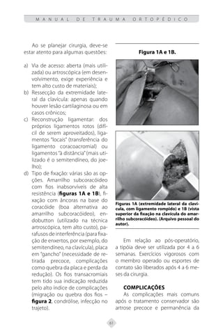 61
M A N U A L D E T R A U M A O R T O P É D I C O
Ao se planejar cirurgia, deve-se
estar atento para algumas questões:
a) Via de acesso: aberta (mais utili-
zada) ou artroscópica (em desen-
volvimento, exige experiência e
tem alto custo de materiais);
b) Ressecção da extremidade late-
ral da clavícula: apenas quando
houver lesão cartilaginosa ou em
casos crônicos;
c) Reconstrução ligamentar: dos
próprios ligamentos rotos (difí-
cil de serem aproveitados), liga-
mentos “locais” (transferência do
ligamento coracoacromial) ou
ligamentos “à distância”(mais uti-
lizado é o semitendíneo, do joe-
lho);
d) Tipo de fixação: várias são as op-
ções. Amarrilho subcoracóideo
com fios inabsorvíveis de alta
resistência (figuras 1A e 1B), fi-
xação com âncoras na base do
coracóide (boa alternativa ao
amarrilho subcoracóideo), en-
dobutton (utilizado na técnica
artroscópica, tem alto custo), pa-
rafusos de interferência (para fixa-
ção de enxertos, por exemplo, do
semitendíneo, na clavícula), placa
em “gancho” (necessidade de re-
tirada precoce, complicações
como quebra da placa e perda da
redução). Os fios transacromiais
tem tido sua indicação reduzida
pelo alto índice de complicações
(migração ou quebra dos fios –
figura 2, condrólise, infecção no
trajeto).
Figura 1A e 1B.
Figuras 1A (extremidade lateral da claví-
cula, com ligamento rompido) e 1B (vista
superior da fixação na clavícula do amar-
rilho subcoracóideo). (Arquivo pessoal do
autor).
Em relação ao pós-operatório,
a tipóia deve ser utilizada por 4 a 6
semanas. Exercícios vigorosos com
o membro operado ou esportes de
contato são liberados após 4 a 6 me-
ses da cirurgia.
Complicações
As complicações mais comuns
após o tratamento conservador são
artrose precoce e permanência da
 