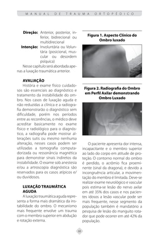 68
M A N U A L D E T R A U M A O R T O P É D I C O
Direção: Anterior, posterior, in-
ferior, bidirecional ou
multidirecional
	Intenção: Involuntária ou Volun-
tária (posicional, mus-
cular ou desordem
psíquica)
Nesse capítulo será abordada ape-
nas a luxação traumática anterior.
Avaliação
História e exame físico cuidado-
sos são essenciais ao diagnóstico e
tratamento da instabilidade do om-
bro. Nos casos de luxação aguda e
não reduzidas a clínica e a radiogra-
fia demonstrarão o diagnóstico sem
dificuldade, porém nos períodos
entre as recorrências, o médico deve
acreditar basicamente no exame
físico e radiológico para o diagnós-
tico, a radiografia pode mostrar al-
terações sutis ou mesmo nenhuma
alteração, nesses casos podem ser
utilizadas a tomografia computa-
dorizada ou ressonância magnética
para demonstrar sinais indiretos da
instabilidade. O exame sob anestesia
e/ou a artroscopia diagnóstica são
reservados para os casos atípicos e/
ou duvidosos.
Luxação Traumática
Aguda
Aluxaçãotraumáticaagudarepre-
senta a forma mais dramática da ins-
tabilidade do ombro. O mecanismo
mais frequente envolve um trauma
com o membro superior em abdução
e rotação externa.
Figura 1. Aspecto Clínico do
Ombro luxado
Figura 2. Radiografia do Ombro
em Perfil Axilar demonstrando
Ombro Luxado
O paciente apresenta dor intensa,
incapacitante e o membro superior
ao lado do corpo em atitude de pro-
teção. O contorno normal do ombro
é perdido, o acrômio fica proemi-
nente (sinal da dragona), e devido a
incongruência articular, a movimen-
tação do membro é limitada. Deve-se
realizar exame neurológico e vascular
pois estima-se lesão do nervo axilar
em até 35% dos casos e nos pacien-
tes idosos a lesão vascular pode ser
mais frequente, nesse segmento da
população também é mandatório a
pesquisa de lesão do manguito rota-
dor que pode ocorrer em até 42% da
população.
 