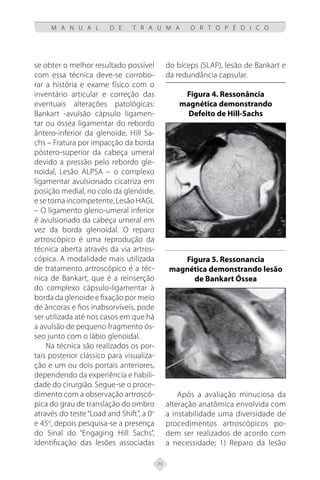 71
M A N U A L D E T R A U M A O R T O P É D I C O
se obter o melhor resultado possível
com essa técnica deve-se corrobo-
rar a história e exame físico com o
inventário articular e correção das
eventuais alterações patológicas:
Bankart -avulsão cápsulo ligamen-
tar ou óssea ligamentar do rebordo
ântero-inferior da glenoide, Hill Sa-
chs – Fratura por impacção da borda
póstero-superior da cabeça umeral
devido a pressão pelo rebordo gle-
noidal, Lesão ALPSA – o complexo
ligamentar avulsionado cicatriza em
posição medial, no colo da glenóide,
e se torna incompetente, Lesão HAGL
– O ligamento gleno-umeral inferior
é avulsionado da cabeça umeral em
vez da borda glenoidal. O reparo
artroscópico é uma reprodução da
técnica aberta através da via artros-
cópica. A modalidade mais utilizada
de tratamento artroscópico é a téc-
nica de Bankart, que é a reinserção
do complexo cápsulo-ligamentar à
borda da glenoide e fixação por meio
de âncoras e fios inabsorvíveis, pode
ser utilizada até nos casos em que há
a avulsão de pequeno fragmento ós-
seo junto com o lábio glenoidal.
Na técnica são realizados os por-
tais posterior clássico para visualiza-
ção e um ou dois portais anteriores,
dependendo da experiência e habili-
dade do cirurgião. Segue-se o proce-
dimento com a observação artroscó-
pica do grau de translação do ombro
através do teste “Load and Shift”, a 0o
e 45o
, depois pesquisa-se a presença
do Sinal do “Engaging Hill Sachs”,
identificação das lesões associadas
do bíceps (SLAP), lesão de Bankart e
da redundância capsular.
Figura 4. Ressonância
magnética demonstrando
Defeito de Hill-Sachs
Figura 5. Ressonancia
magnética demonstrando lesão
de Bankart Óssea
Após a avaliação minuciosa da
alteração anatômica envolvida com
a instabilidade uma diversidade de
procedimentos artroscópicos po-
dem ser realizados de acordo com
a necessidade: 1) Reparo da lesão
 