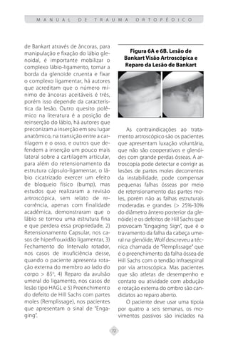 72
M A N U A L D E T R A U M A O R T O P É D I C O
de Bankart através de âncoras, para
manipulação e fixação do lábio gle-
noidal, é importante mobilizar o
complexo lábio-ligamento, tornar a
borda da glenoide cruenta e fixar
o complexo ligamentar, há autores
que acreditam que o número mí-
nimo de âncoras aceitáveis é três,
porém isso depende da caracterís-
tica da lesão. Outro quesito polê-
mico na literatura é a posição de
reinserção do lábio, há autores que
preconizam a inserção em seu lugar
anatômico, na transição entre a car-
tilagem e o osso, e outros que de-
fendem a inserção um pouco mais
lateral sobre a cartilagem articular,
para além do retensionamento da
estrutura cápsulo-ligamentar, o lá-
bio cicatrizado exercer um efeito
de bloqueio físico (bump), mas
estudos que realizaram a revisão
artroscópica, sem relato de re-
corrência, apenas com finalidade
acadêmica, demonstraram que o
lábio se tornou uma estrutura fina
e que perdera essa propriedade, 2)
Retensionamento Capsular, nos ca-
sos de hiperfrouxidão ligamentar, 3)
Fechamento do Intervalo rotador,
nos casos de insuficiência desse,
quando o paciente apresenta rota-
ção externa do membro ao lado do
corpo > 85o
, 4) Reparo da avulsão
umeral do ligamento, nos casos de
lesão tipo HAGL e 5) Preenchimento
do defeito de Hill Sachs com partes
moles (Remplissage), nos pacientes
que apresentam o sinal de “Enga-
ging”.
Figura 6A e 6B. Lesão de
Bankart Visão Artroscópica e
Reparo da Lesão de Bankart
As contraindicações ao trata-
mento artroscópico são os pacientes
que apresentam luxação voluntária,
que não são cooperativos e glenói-
des com grande perdas ósseas. A ar-
troscopia pode detectar e corrigir as
lesões de partes moles decorrentes
da instabilidade, pode compensar
pequenas falhas ósseas por meio
de retensionamento das partes mo-
les, porém não as falhas estruturais
moderadas e grandes (> 25%-30%
do diâmetro ântero posterior da gle-
nóide) e os defeitos de Hill Sachs que
provocam “Engaging Sign”, que é o
travamento da falha da cabeça ume-
ral na glenóide, Wolf descreveu a téc-
nica chamada de “Remplissage” que
é o preenchimento da falha óssea de
Hill Sachs com o tendão Infraespinal
por via artroscópica. Mas pacientes
que são atletas de desempenho e
contato ou atividade com abdução
e rotação externa do ombro são can-
didatos ao reparo aberto.
O paciente deve usar uma tipoia
por quatro a seis semanas, os mo-
vimentos passivos são iniciados na
 