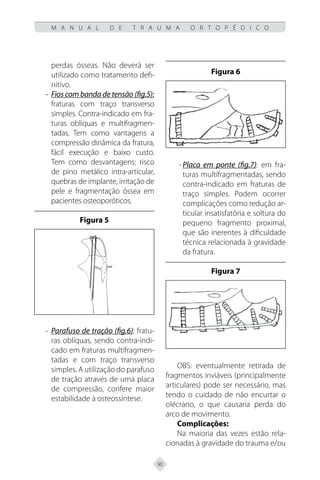 90
M A N U A L D E T R A U M A O R T O P É D I C O
perdas ósseas. Não deverá ser
utilizado como tratamento defi-
nitivo.
- Fios com banda de tensão (fig.5):
fraturas com traço transverso
simples. Contra-indicado em fra-
turas oblíquas e multifragmen-
tadas. Tem como vantagens a
compressão dinâmica da fratura,
fácil execução e baixo custo.
Tem como desvantagens: risco
de pino metálico intra-articular,
quebras de implante, irritação de
pele e fragmentação óssea em
pacientes osteoporóticos.
Figura 5
- Parafuso de tração (fig.6): fratu-
ras oblíquas, sendo contra-indi-
cado em fraturas multifragmen-
tadas e com traço transverso
simples. A utilização do parafuso
de tração através de uma placa
de compressão, confere maior
estabilidade à osteossíntese.
Figura 6
- Placa em ponte (fig.7): em fra-
turas multifragmentadas, sendo
contra-indicado em fraturas de
traço simples. Podem ocorrer
complicações como redução ar-
ticular insatisfatória e soltura do
pequeno fragmento proximal,
que são inerentes à dificuldade
técnica relacionada à gravidade
da fratura.
Figura 7
OBS: eventualmente retirada de
fragmentos inviáveis (principalmente
articulares) pode ser necessário, mas
tendo o cuidado de não encurtar o
olécrano, o que causaria perda do
arco de movimento.
Complicações:
Na maioria das vezes estão rela-
cionadas à gravidade do trauma e/ou
 