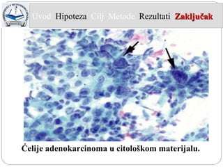 Ćelije adenokarcinoma u citološkom materijalu. Uvod  Hipoteza   Cilj  Metode   Rezultati   Zaključak   