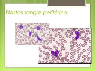 Blastos sangre periférica
 