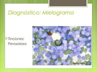 Diagnóstico: Mielograma



 Tinciones:

 Peroxidasa
 