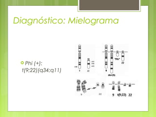 Diagnóstico: Mielograma



  Phi(+):
 t(9;22)(q34;q11)
 