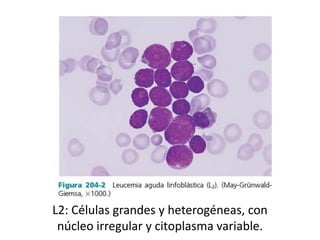 L2: Células grandes y heterogéneas, con
núcleo irregular y citoplasma variable.
 