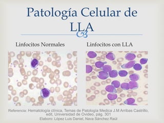 
Linfocitos Normales Linfocitos con LLA
Patología Celular de
LLA
Referencia: Hematología clínica, Temas de Patología Medica J.M Arribas Castrillo,
edit, Universidad de Ovideo, pág. 301
Elaboro: López Luis Daniel, Nava Sánchez Raúl
 